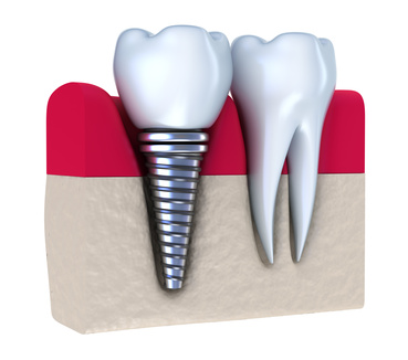 Implantat mit Krone