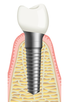 schraubenimplantat