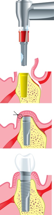 Implantationsverlauf