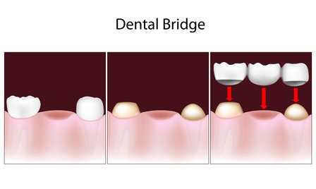 dental brücken