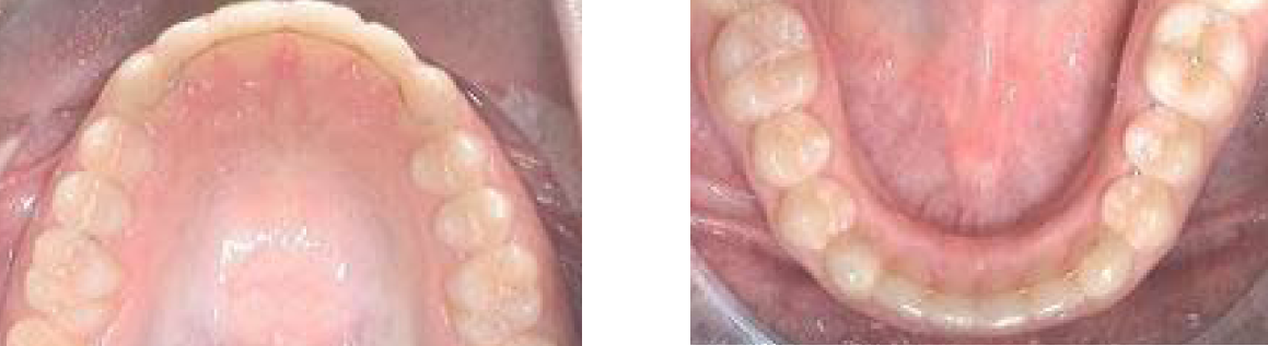 Ober- und Unterkiefer, intraoral fotografiert