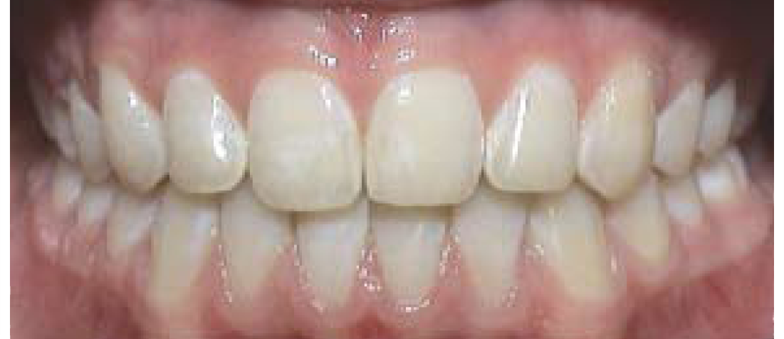 Weisse Zahne Schmelzfleckenbehandlung Kfo Zahnarztportal