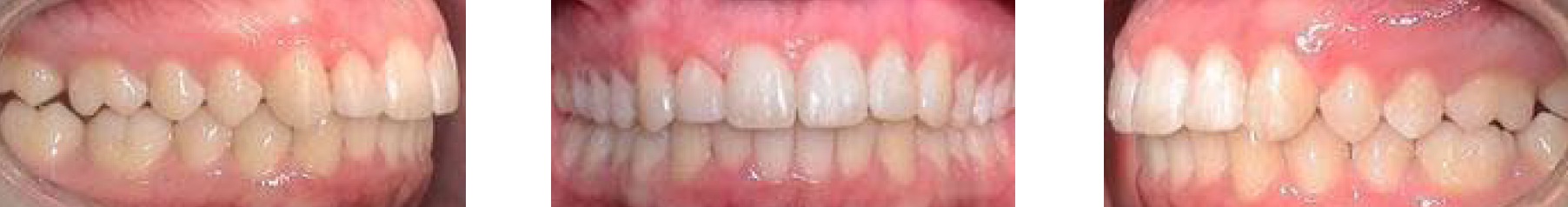Zähne in Okklusion, frontale sowie seitliche Aufnahmen