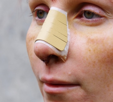 Nase ist durch Gipsverband stabilisiert