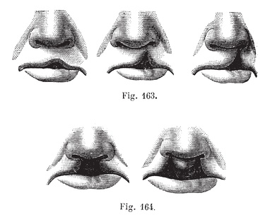 Lippenspalte, einfach und doppelt