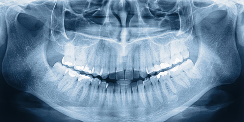 Panoramaaufnahme eine Zahnsystems