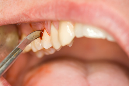 Behandlung einer Zahnfleischentzündung (Gingivitis)