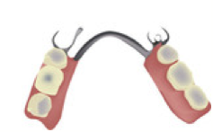 Teilprothese