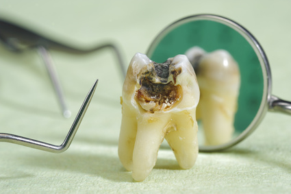 Kariöser Zahn 